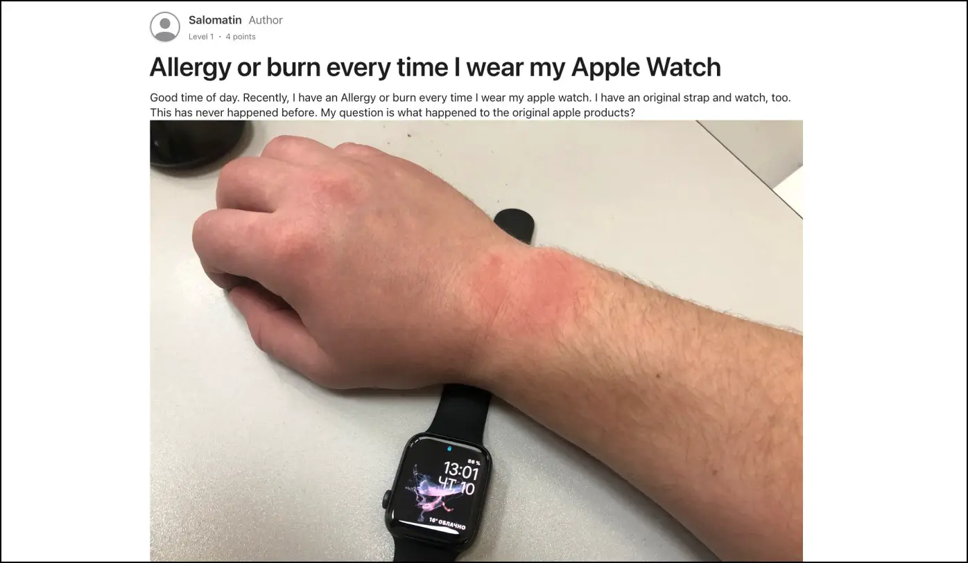 Apple Watch Skin Burn Rash